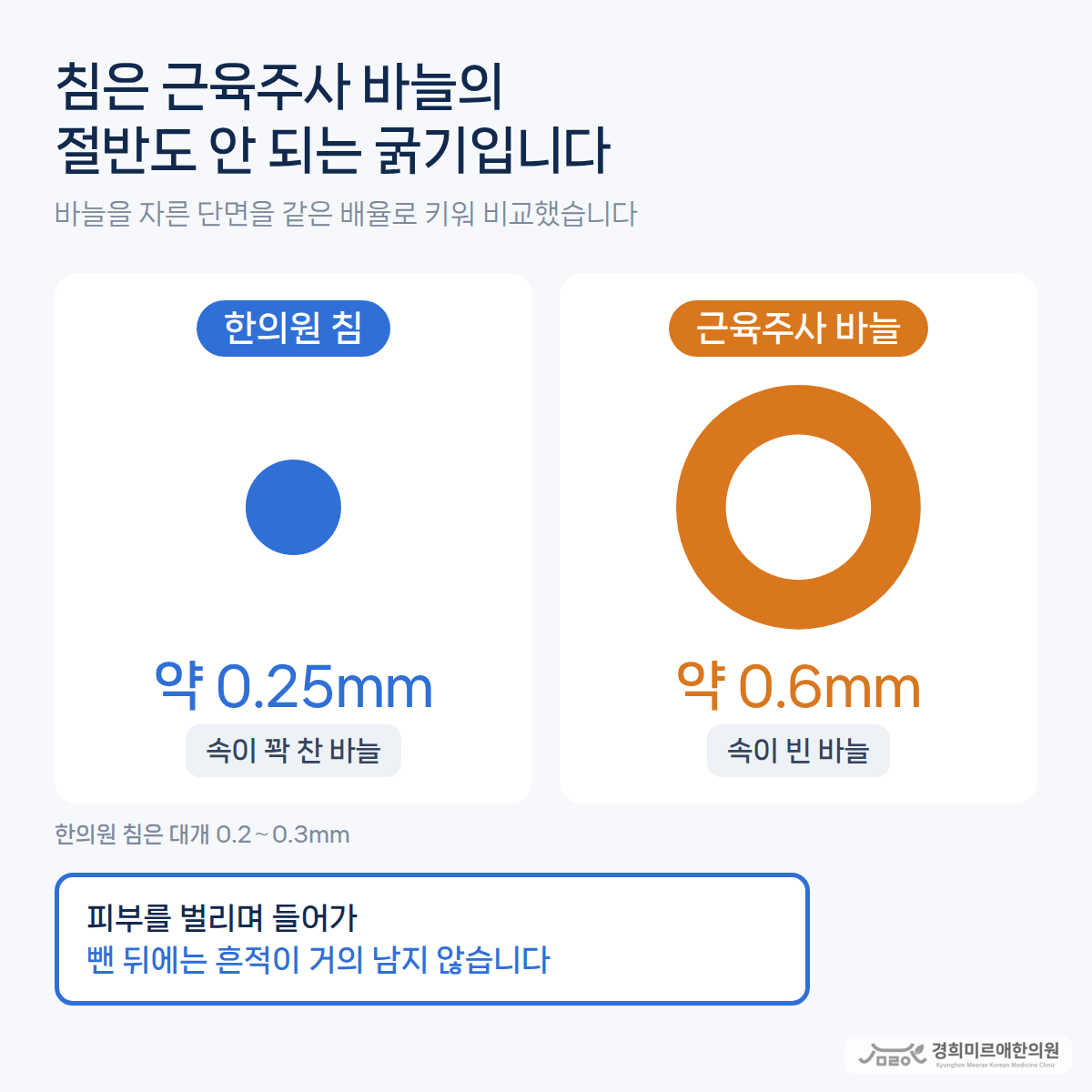 한의원 침(지름 약 0.25mm, 속이 꽉 찬 바늘)과 근육주사 바늘(지름 약 0.6mm, 속이 빈 바늘)의 굵기를 같은 배율로 비교한 도식 — 경희미르애한의원 보라매 침 굵기
