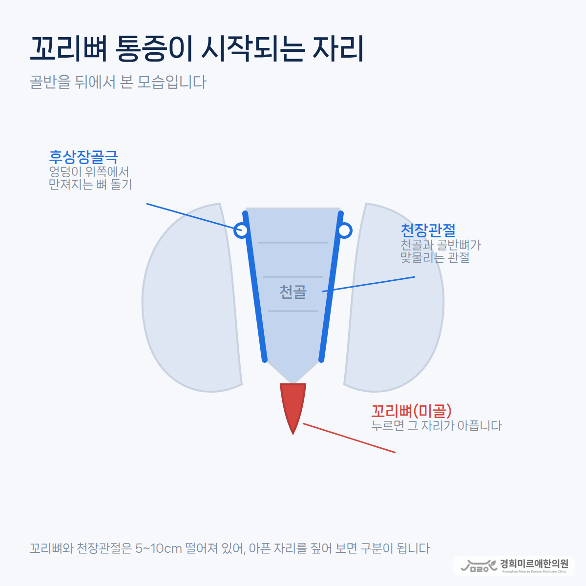 천골·꼬리뼈·천장관절의 위치를 표시한 골반 뒤쪽 도식 — 경희미르애한의원 보라매 꼬리뼈 통증 감별