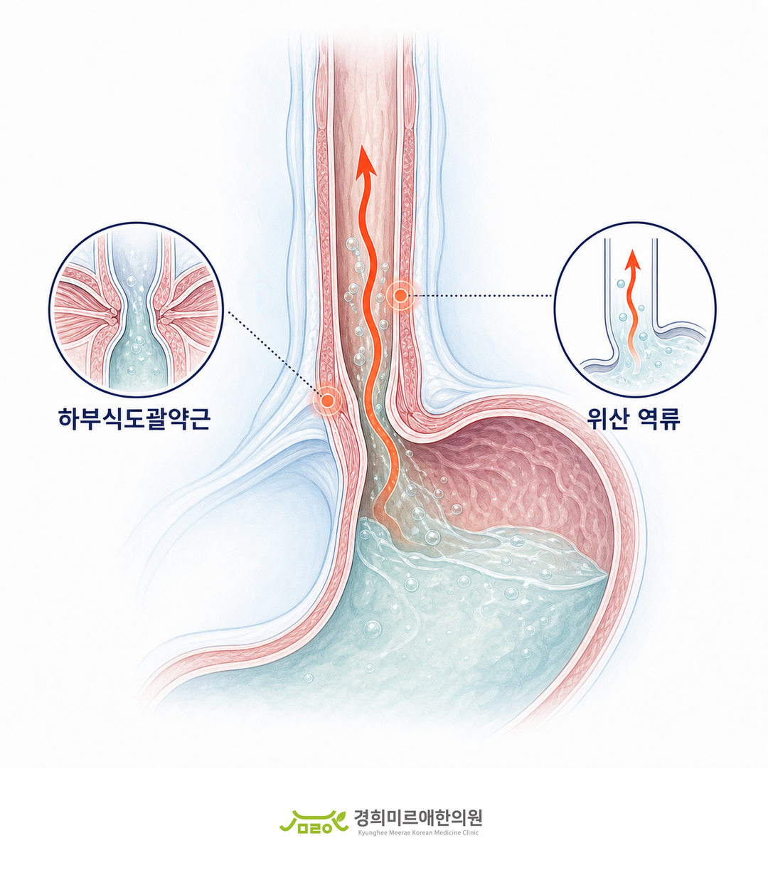 위와 식도가 만나는 부위에서 위산이 역류하는 경로 도식 — 경희미르애한의원 보라매 역류성 식도염 설명