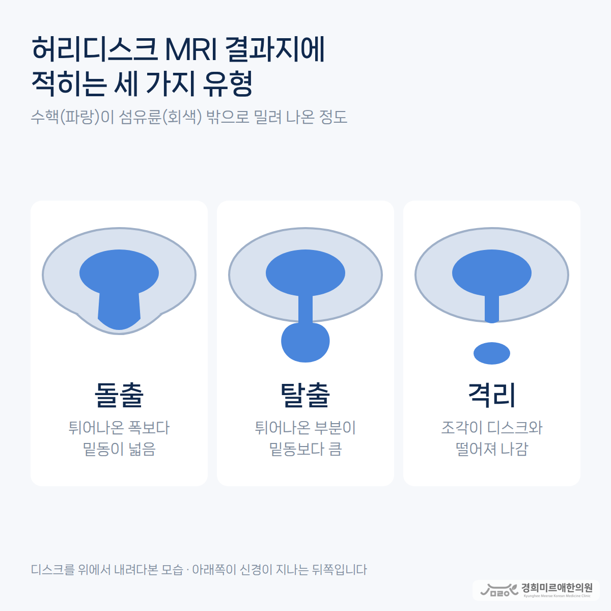 허리디스크 MRI를 다시 찍었는데 그대로라면