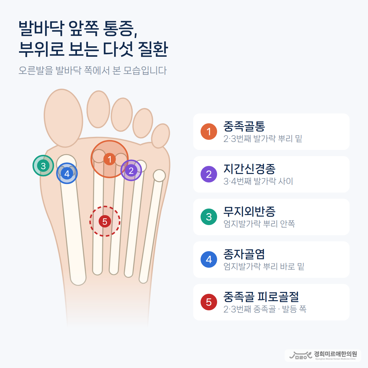 발바닥 앞쪽이 아프다면 지간신경종인가요?