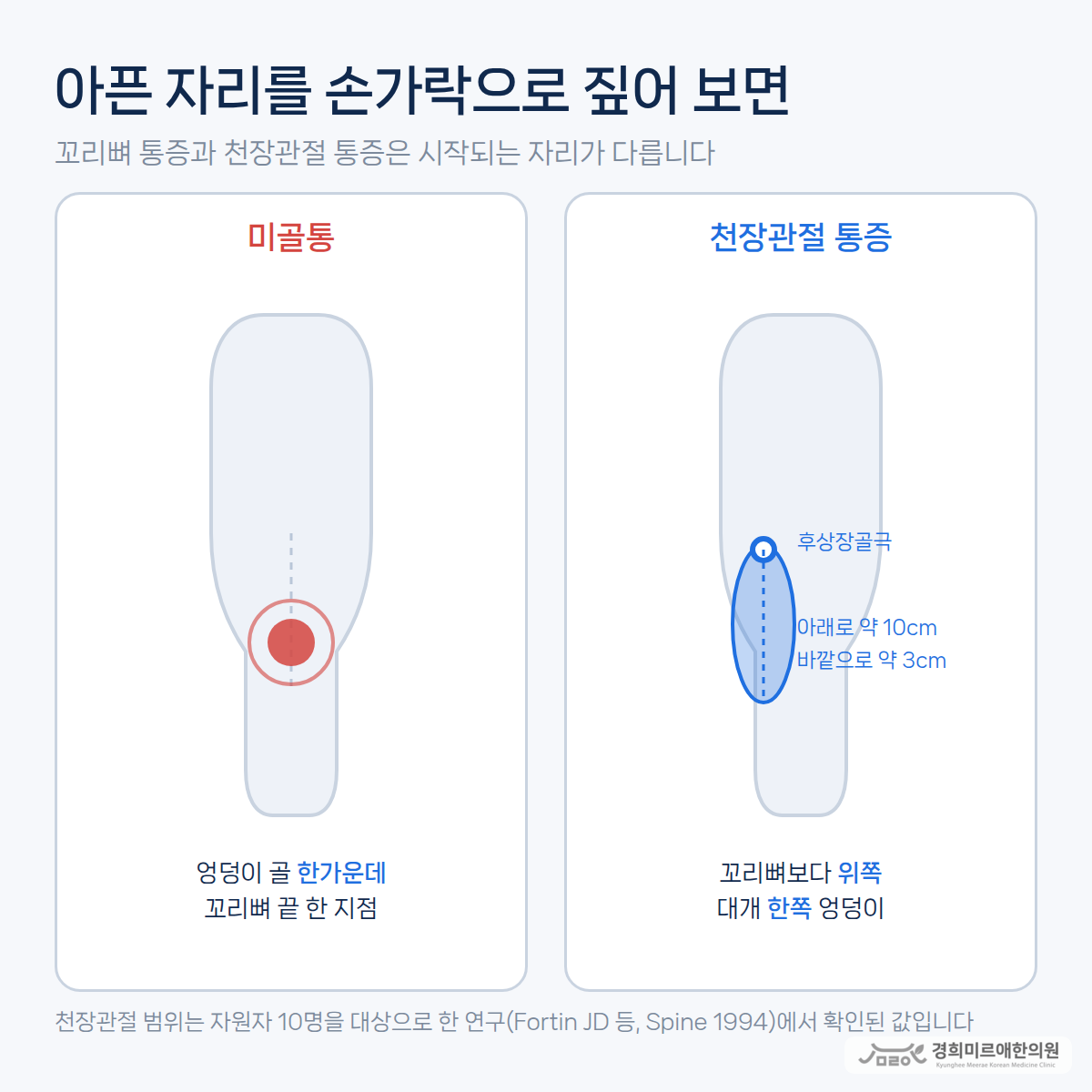 천장관절 연관통 범위와 꼬리뼈 압통점을 비교한 도식 — 경희미르애한의원 보라매 천장관절 감별